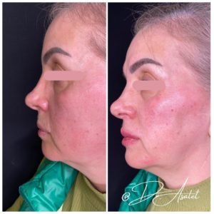 Reduce Nasolabial Folds in Harley Street London and Southampton