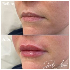 Lip Plumping Treatments in Hampshire