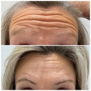 brow lifting at azra beauty clinics in London's Harley Street