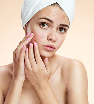 Treatments For Skin Acne