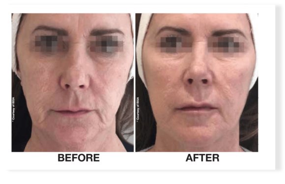 Reduce Fine Lines & Wrinkles with Profhilo® Skin Boosting Injections in Southampton & Harley Street, London