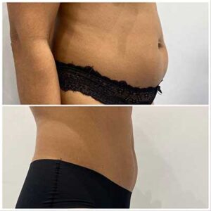 Fat Dissolving Injections in Harley Street, London & Southampton